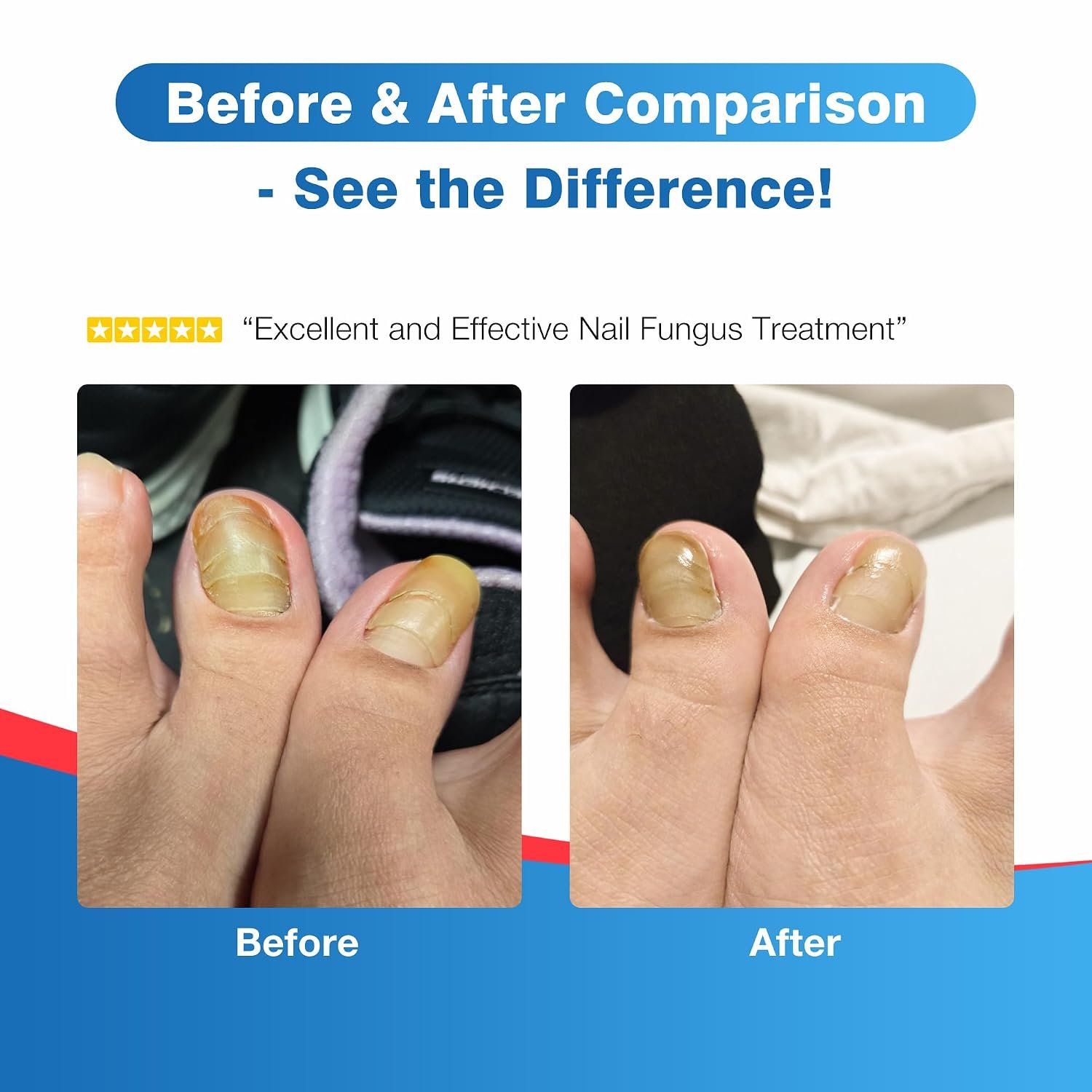 Toenail Fungus Treatment Extra Strength - DR.RAPID Toenail Fungus Treatment Pen with 25% Undecylenic Acid & Tolnaftate, Ideal for Fungus Treatment for Damaged Nails & Fingernails 5ml/0.18FLOZ 3Pcs - Image 6