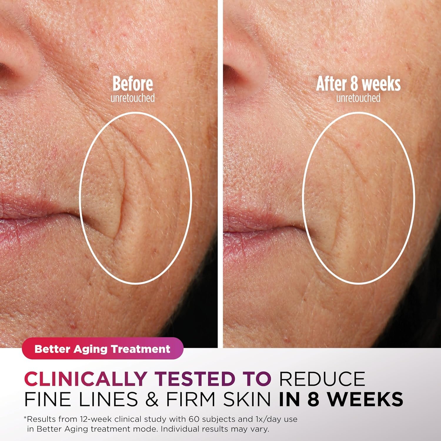 Shark CryoGlow LED Face Mask in Lilac Frost, FW312PL | #1 Skincare Facial Device in the US, Combining High-Energy LEDs, Deep Infrared & Under-Eye Cooling - Image 5